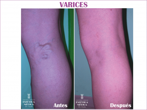 Eliminaci�n varices 02